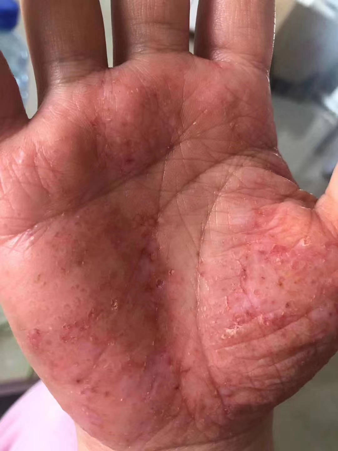 治湿疹偏方(治湿疹最有效的小偏方)